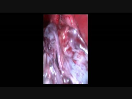 Laparoscopic Extera Gist