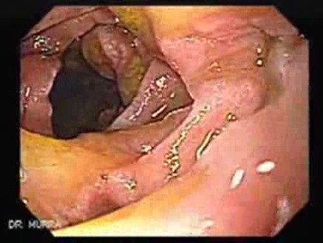 Gastroduodenal MALT lymphoma (4 of 9)
