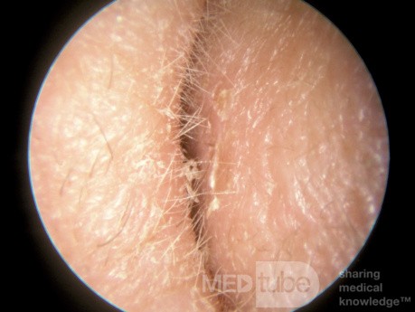 Collapsing External Auditory Canal