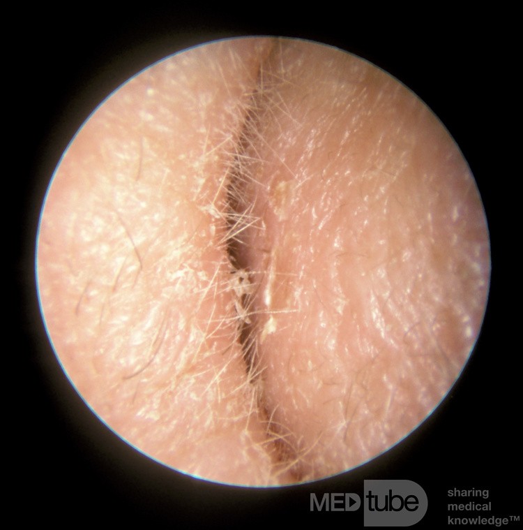 Collapsing External Auditory Canal