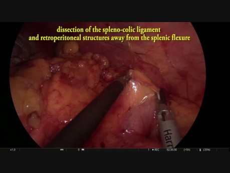 Laparoscopic Intersphincteric Resection with Diverting ileostomy