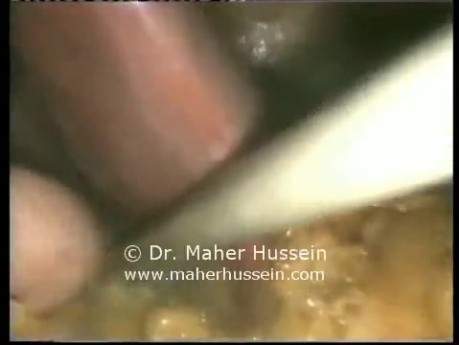 Laparoscopic Right Adrenalectomy