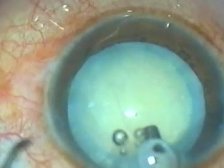 Continuous Curvilinear Capsulotomy - Fugo Blade