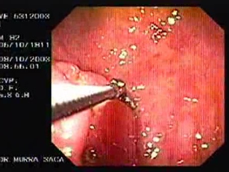 Irregular Ulcer at the Corpus - Biopsy