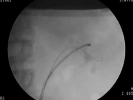 RIRS - Fluoroscopic View
