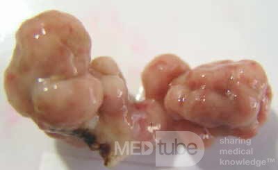 Colonoscopic Polypectomy (25 of 29)