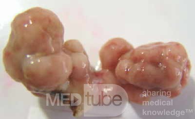 Colonoscopic Polypectomy (25 of 29)