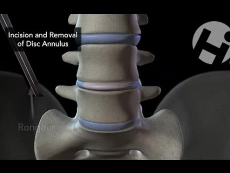 Discectomy and Interbody Fusion