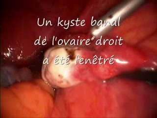 Laparoscopic Ovariectomy Due To Ovarian Cyst