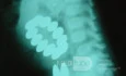 Foreign Body Multiple Magnets Ingestion