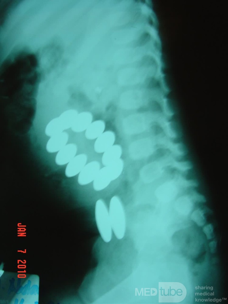 Foreign Body Multiple Magnets Ingestion
