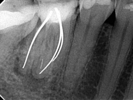Removing Intracanal Blockages - Silver Cones and Apically Located Broken File