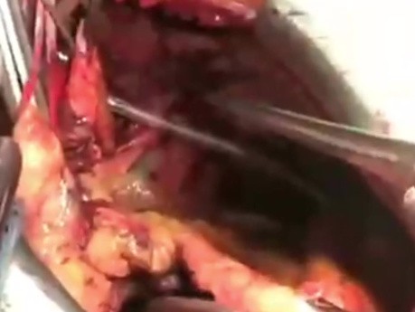 Implanting Total Artificial Heart