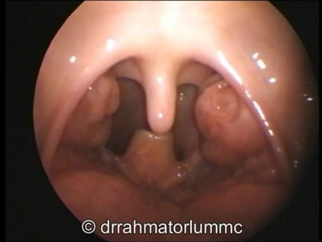 Child's Throat - 5 year old