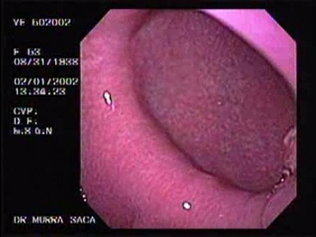 Gastric Polyps - Endoscopy (1 of 3)