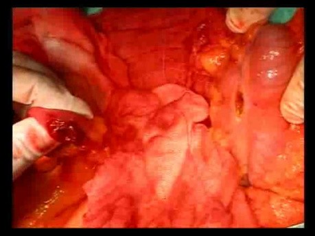Open Right Hemicolectomy – Technical Principles - Operation No 1B - Part 5