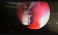 Nasal Foreign Body, a Metal Nut