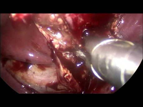 Laparoscopic Cholecystectomy for Acute Calculous Cholecystitis