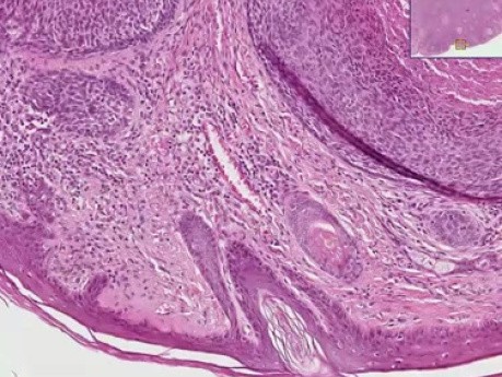 Basal cell carcinoma