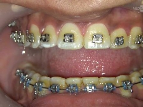 Orthodontic Torque Spring for Negative Torque