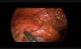 Laparoscopic Partial Colon Resection Using a Stapler Technique in 16 Year Old Girl