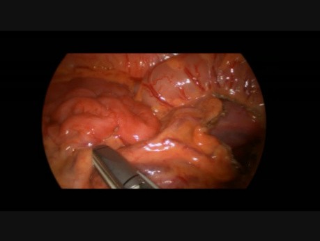 Laparoscopic Partial Colon Resection Using a Stapler Technique in 16 Year Old Girl