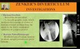 Zenker's Diverticulum - Dysphagia
