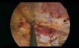 Laparoscopic Triple Neurectomy for Cronic Pain After Inguinal Hernia Repair