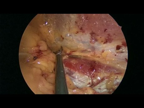 Laparoscopic Triple Neurectomy for Cronic Pain After Inguinal Hernia Repair
