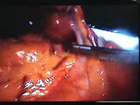 Jejunal Gastrointestinal Stromal tumor (GIST) (28 of 86)