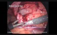 Laparopscopic Inguinal Hernia Repair (TAPP), Step by Step