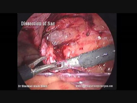 Laparopscopic Inguinal Hernia Repair (TAPP), Step by Step