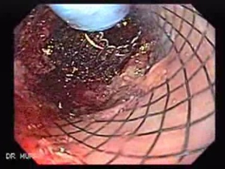 Placement Of The Esophageal Stent - 5/12