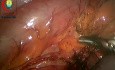 Laparoscopic Sigmoidectomy for Volvulus 