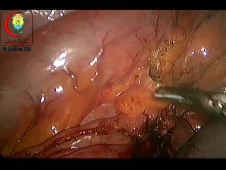 Laparoscopic Sigmoidectomy for Volvulus 