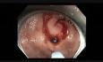 Colonoscopy - Rectum - APC of Bleeding Angioectasia
