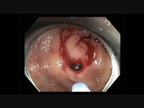 Colonoscopy - Rectum - APC of Bleeding Angioectasia