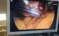 Chronic Tubal Ectopic Pregnancy, Surgical Case