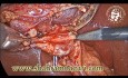 Laparoscopic Cholecystectomy Fine Dissection and Anatomy