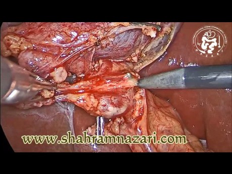 Laparoscopic Cholecystectomy Fine Dissection and Anatomy