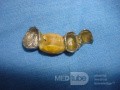 Dental Prothesis Found in the Jejuno (7 of 9)
