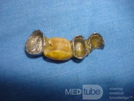 Dental Prothesis Found in the Jejuno (7 of 9)
