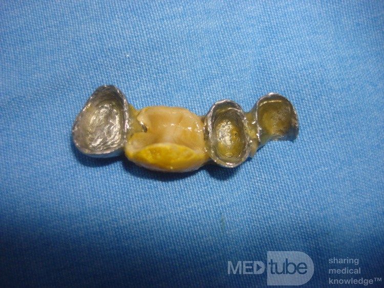 Dental Prothesis Found in the Jejuno (7 of 9)