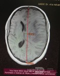 Decompressive Craniotomy