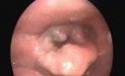 Supraglottic Carcinoma Of Larynx