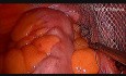 Laparoscopic IPOM repair of Inguinal Hernia