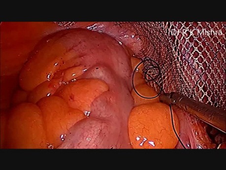 Laparoscopic IPOM repair of Inguinal Hernia