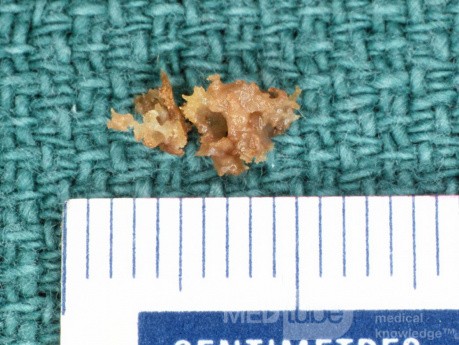 Sequestrum from Irraiation Osteitis Mastoid
