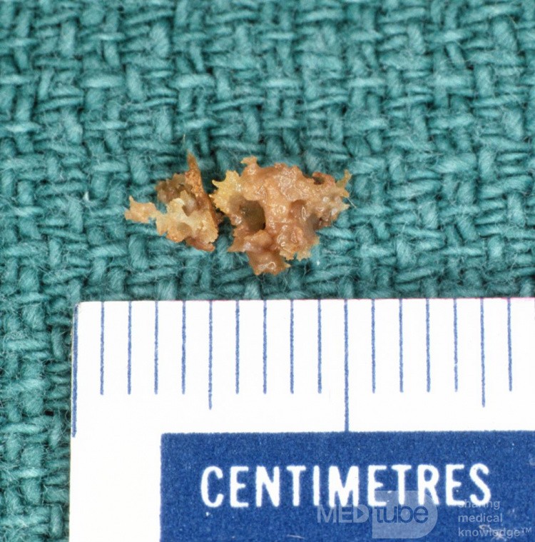 Sequestrum from Irraiation Osteitis Mastoid