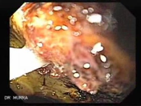 Gastrointestinal Bleeding Caused by Advanced Gastric Carcinoma - Absolute Alcohol Injections